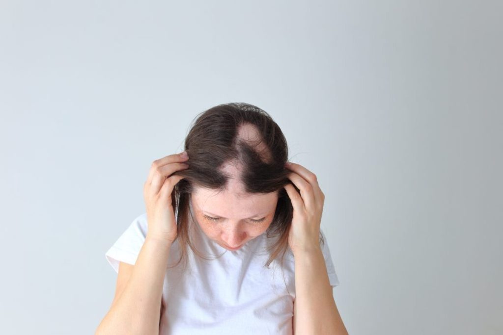 Gut microbiome effect on Alopecia